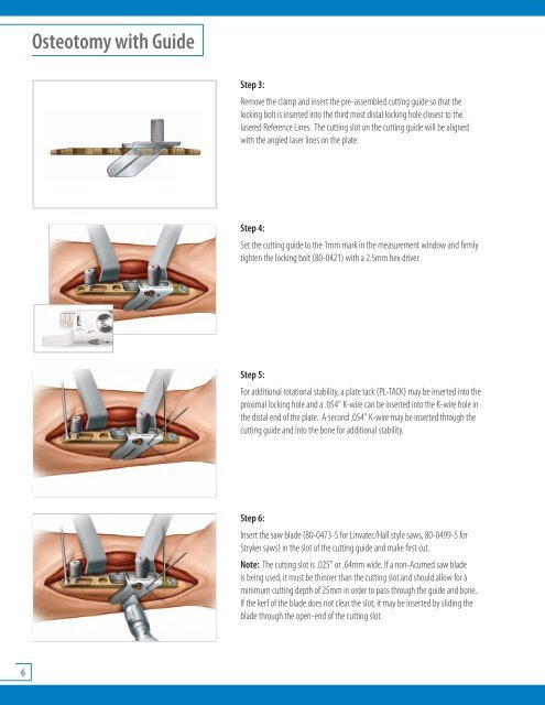 Acumed Ulna Shortening System.pdf - Osteosyntese