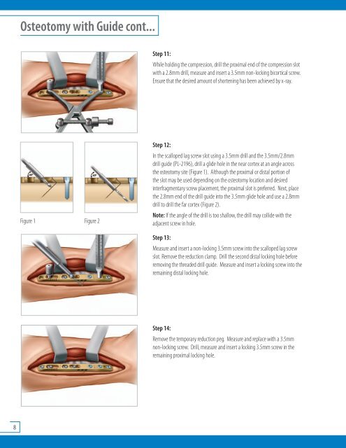 Acumed Ulna Shortening System.pdf - Osteosyntese