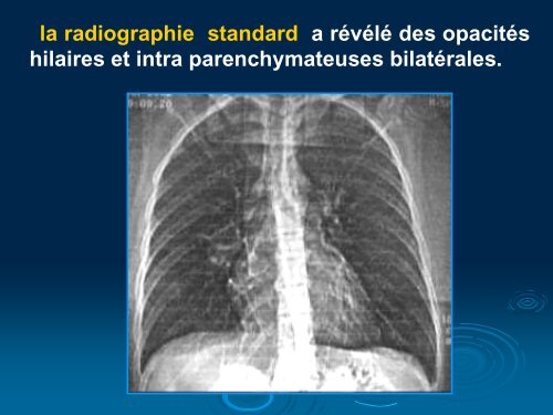 anevrysme des arteres pulmonaires au cours de la maladie de ...