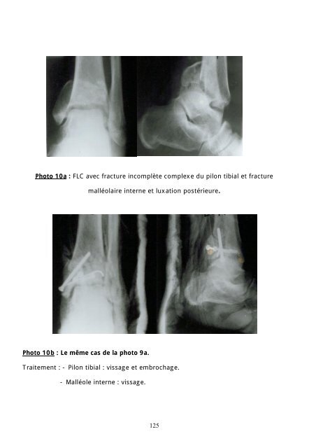 FRACTURE-LUXATION DE LA CHEVILLE - Toubkal