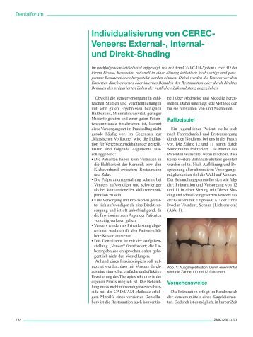 Individualisierung von CERECVeneers - werling-consulting.de