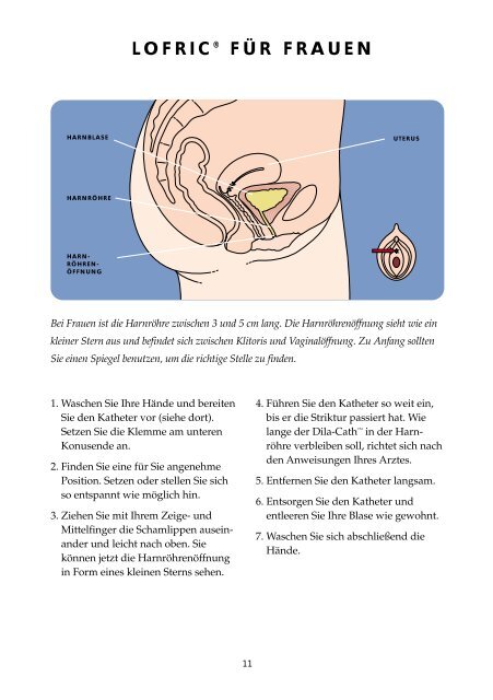 PATIENTENRATGEBER ZUR SELBSTDILATATION - Astra Tech