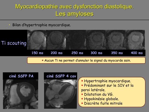 SÃ©quence de rehaussement tardif en IRM myocardique: techniques ...