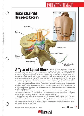 Epidural Injection pdf - U.S. Pharmacist