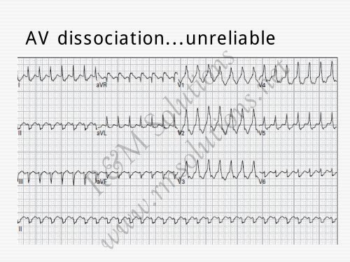 QRS amplitude - cardioegypt2011