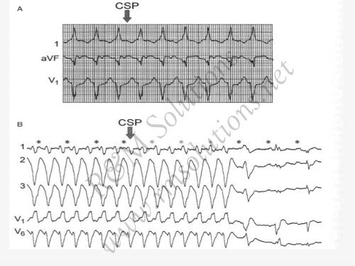 QRS amplitude - cardioegypt2011