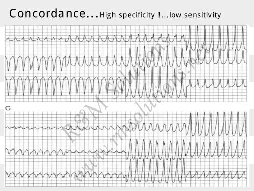 QRS amplitude - cardioegypt2011