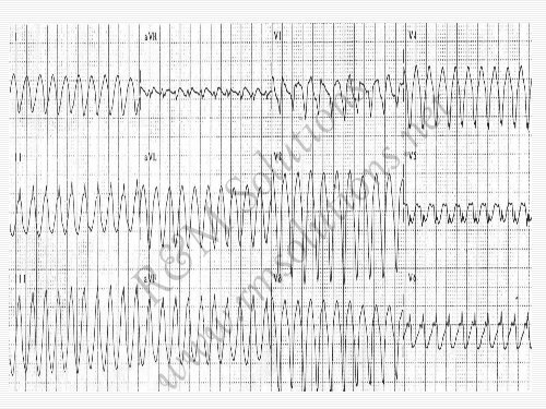 QRS amplitude - cardioegypt2011