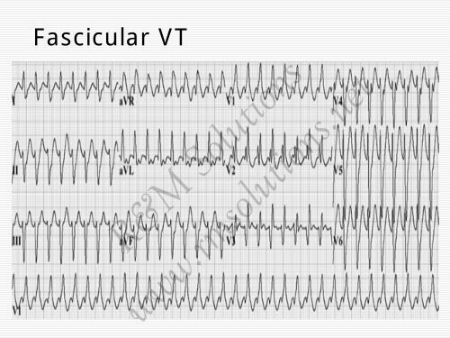 QRS amplitude - cardioegypt2011