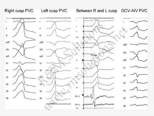 QRS amplitude - cardioegypt2011