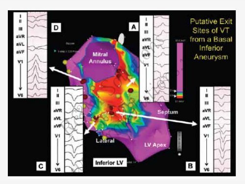 QRS amplitude - cardioegypt2011