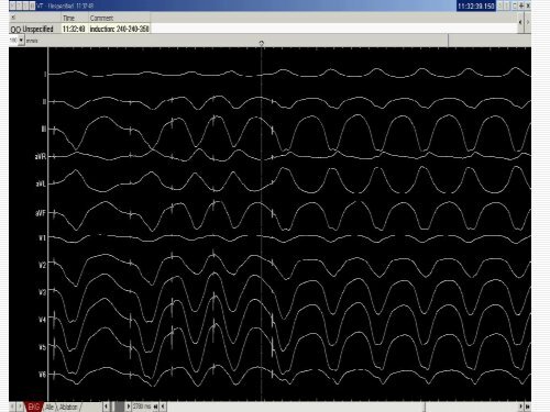 QRS amplitude - cardioegypt2011