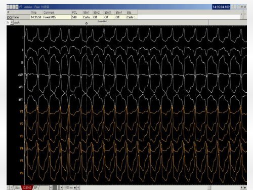 QRS amplitude - cardioegypt2011