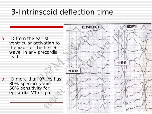 QRS amplitude - cardioegypt2011