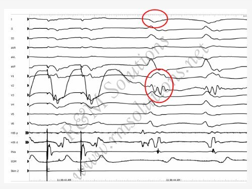 QRS amplitude - cardioegypt2011