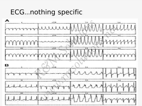 QRS amplitude - cardioegypt2011