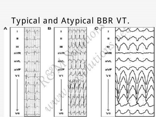 QRS amplitude - cardioegypt2011