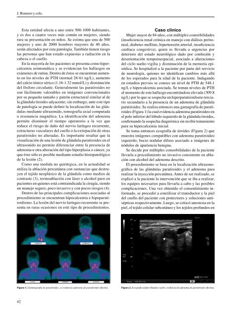 Alternativa no quirúrgica para el tratamiento del ... - SciELO Colombia