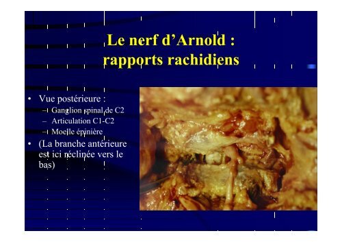 Anatomie du grand nerf occipital - sofmmoo