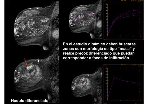 CASO 5: CDIS Y FOCO DE CARCINOMA INFILTRANTE Paciente ...