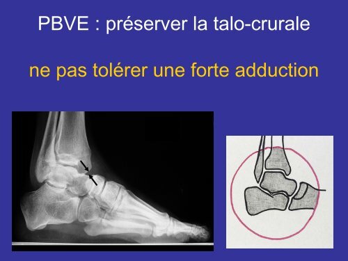 LE PIED - SOFOP