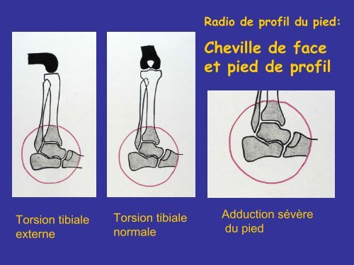 LE PIED - SOFOP