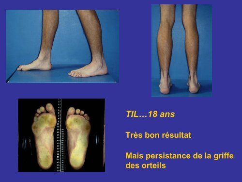 LE PIED - SOFOP