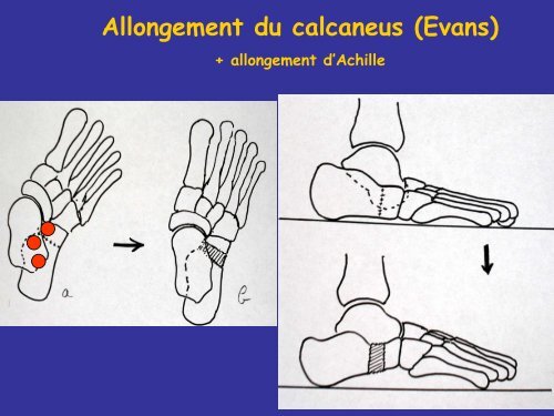 LE PIED - SOFOP