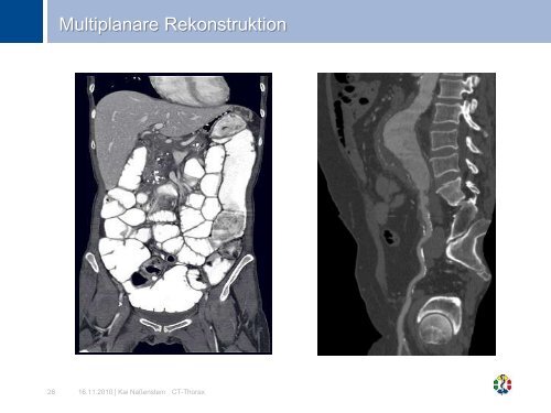 CT Thorax