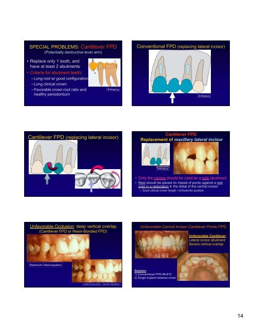 1 FIXED PARTIAL DENTURES