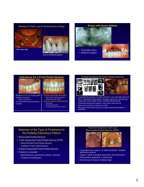 1 FIXED PARTIAL DENTURES