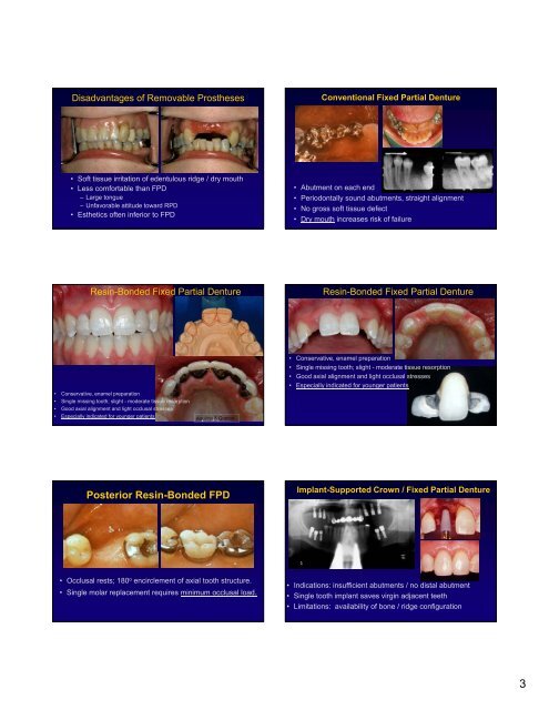 1 FIXED PARTIAL DENTURES