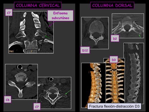 fracturas columna