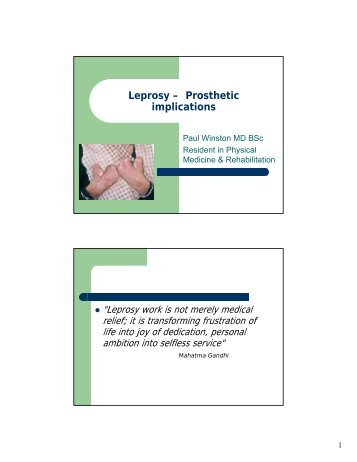 Leprosy â Prosthetic implications