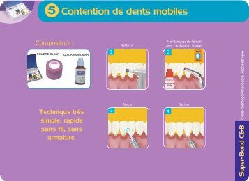 Contention de dents mobiles