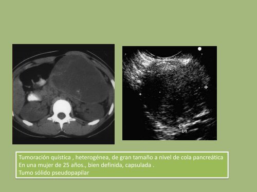 TEXTURA HETEROGENEA. Degeneracin quística