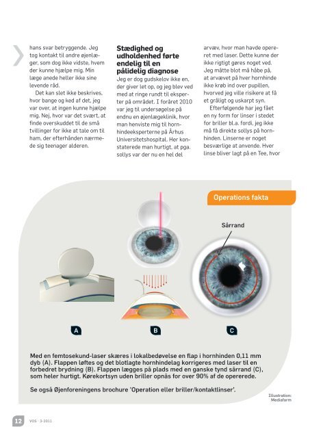 Laser- behandling af hornhinder - Øjenforeningen Værn om Synet