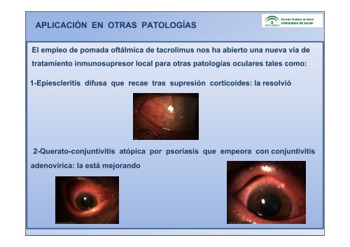 pomada oftalmica de tacrolimus al 0.02% para el tratamiento de la ...