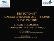 detection et caracterisation des thrombi du vg par irm