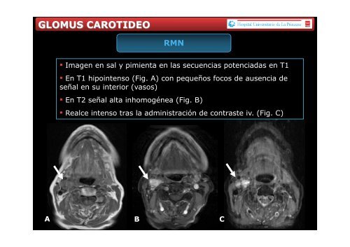 POSTER DE PARAGANGLIOMAS 28 ABRIL