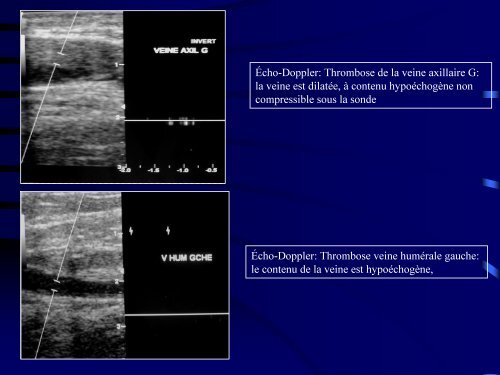 apport de l'imagerie dans le diagnostic et le bilan d'extension d'une ...