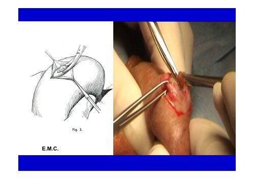 AZOOSPERMIE ET CHIRURGIE VASECTOMIE ECU 2012 - Toulandro