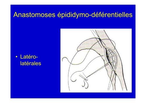 AZOOSPERMIE ET CHIRURGIE VASECTOMIE ECU 2012 - Toulandro