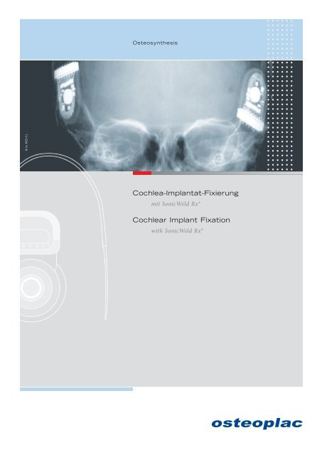 Cochlea-Implantat-Fixierung Cochlear Implant Fixation - Osteoplac