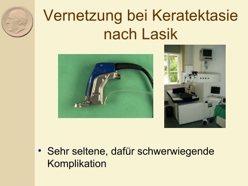 Behandlung der Keratektasie nach Lasik