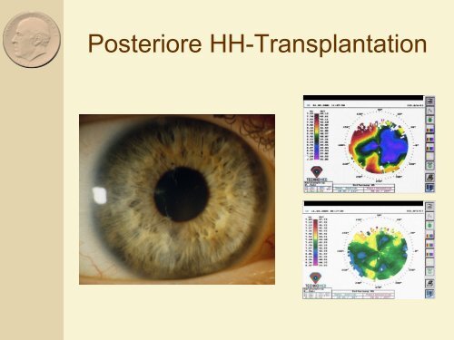 Behandlung der Keratektasie nach Lasik