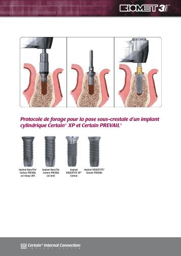 Protocole de forage pour la pose sous-crestale d'un ... - BIOMET 3i