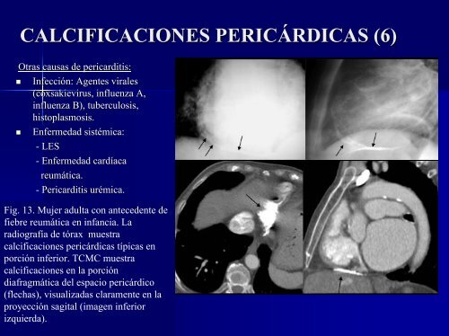 calcificaciones miocárdicas - 30 Congreso de la SERAM. A Coruña ...