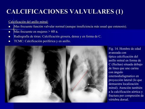 calcificaciones miocárdicas - 30 Congreso de la SERAM. A Coruña ...