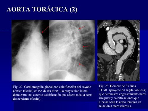 calcificaciones miocárdicas - 30 Congreso de la SERAM. A Coruña ...